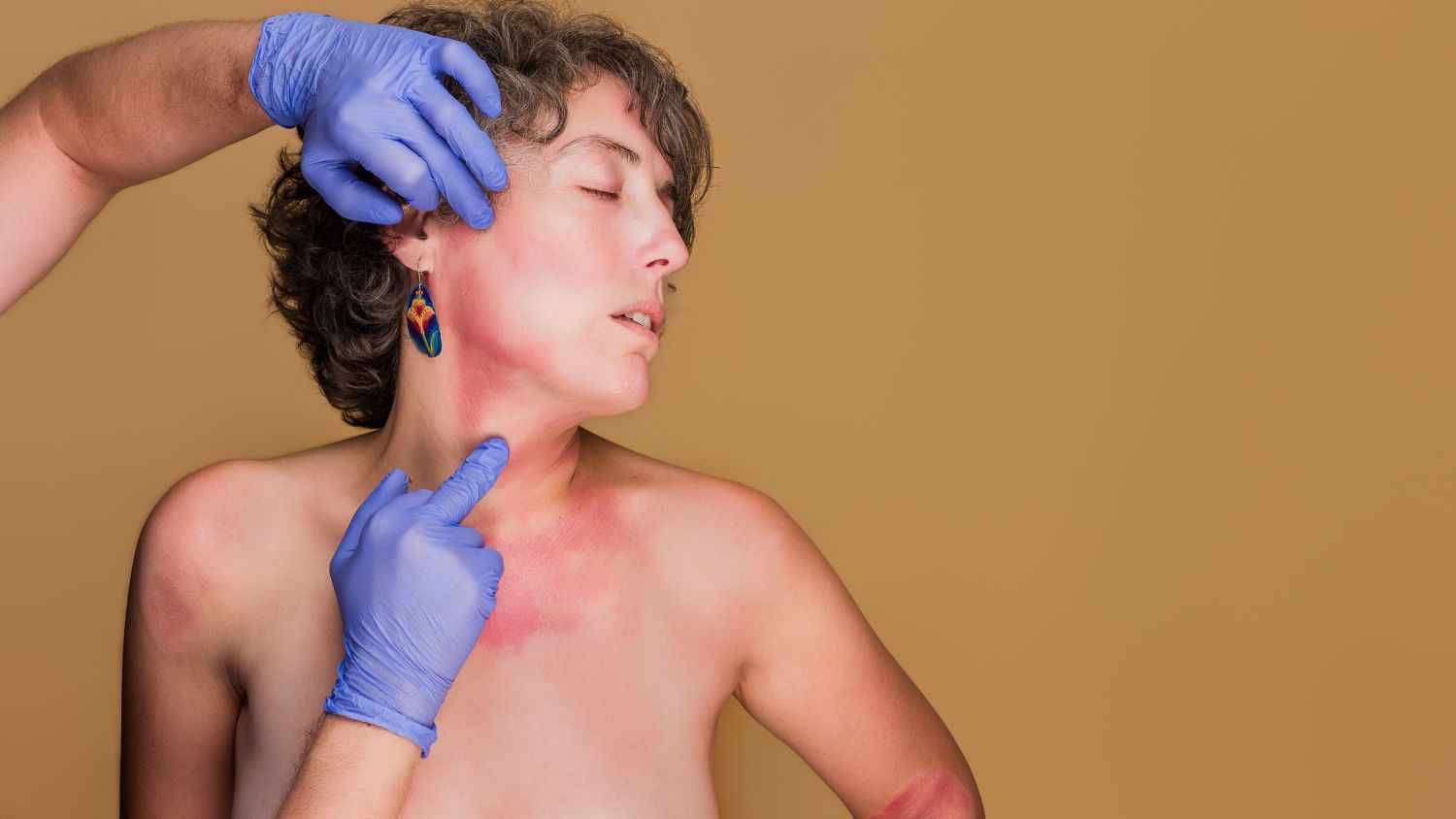 Radiation Dermatitis